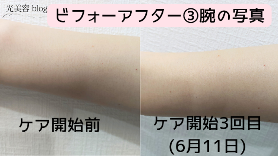 Ulike Air 10 Max IPL光美容器のビフォーアフター写真③