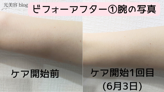 Ulike Air 10 Max IPL光美容器のビフォーアフター写真①