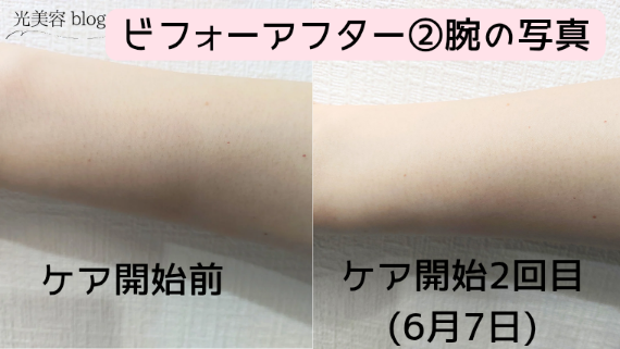 Ulike Air 10 Max IPL光美容器のビフォーアフター写真②